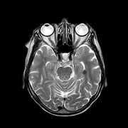 A brain top x-ray